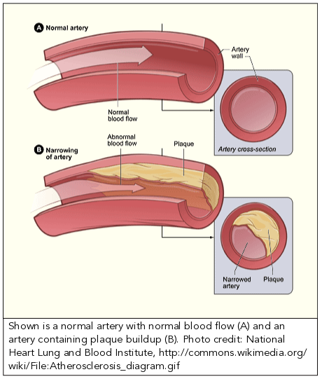 picture of a normal artery with normal blood flow and an artery containing plaque buildup
