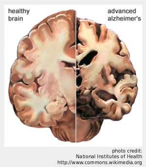 Comparison of healthy brain and advanced Alzheimer's