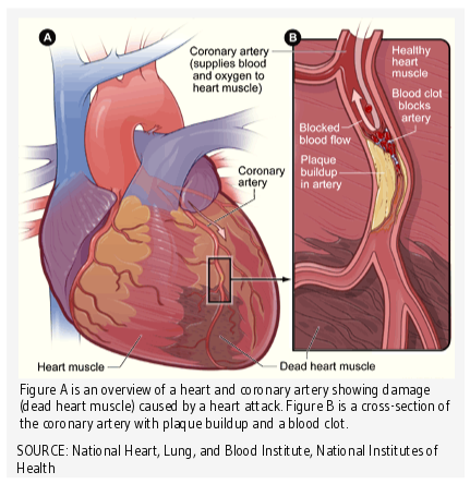 overview of a heart and coronary artery showing damage (dead heart muscle) caused by a heart attack. Also shown is a cross-section of the coronary artery with plaque buildup and a blood clot.
