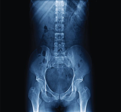 X‑ray image of the lower spine, pelvis, and hips