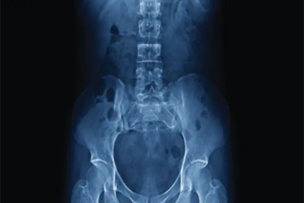 X‑ray image of the lower spine, pelvis, and hips